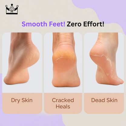 GlowStep™ - Callus Remover For Feet