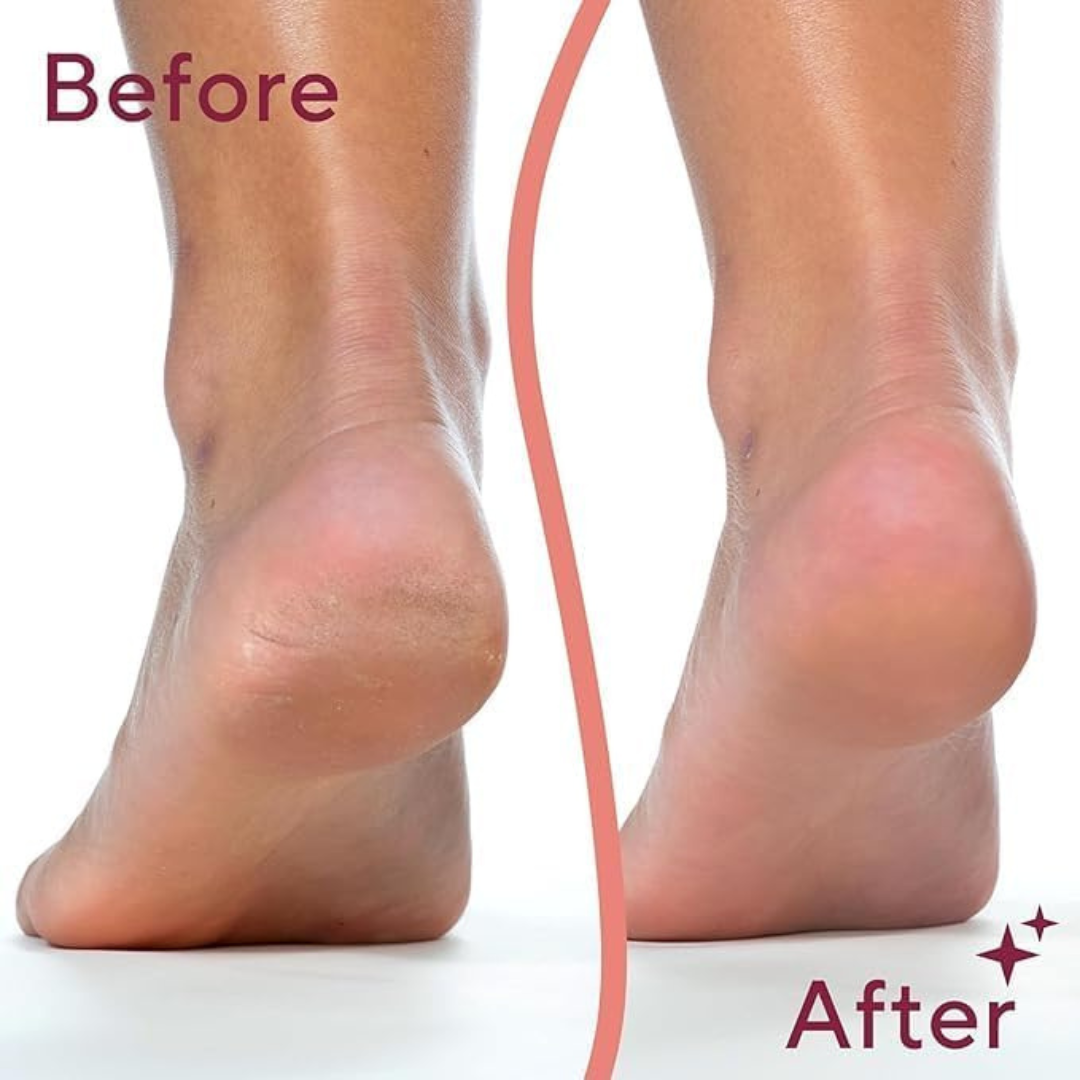 GlowStep™ - Callus Remover For Feet